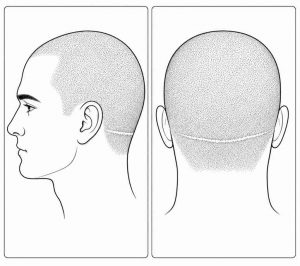 Hair transplant scar
